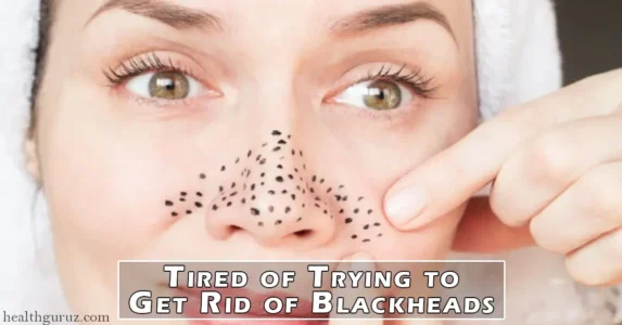 Tired of Trying to Get Rid of Blackheads